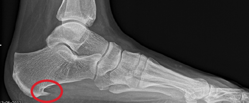 Hielspoor op röntgenfoto